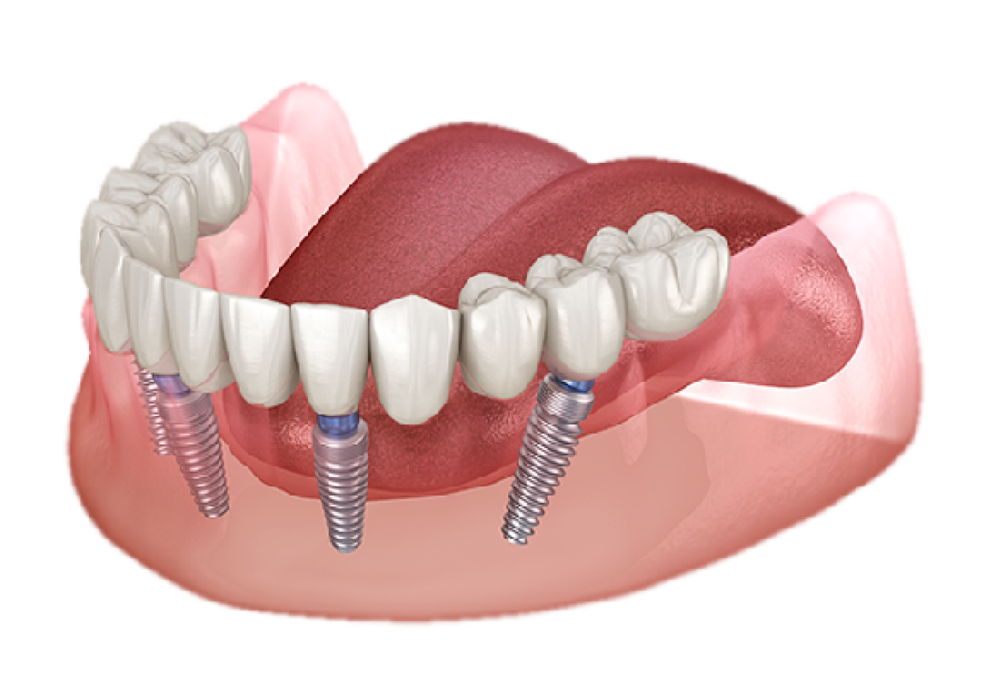 PMMA single-arch All-on-X prosthesis